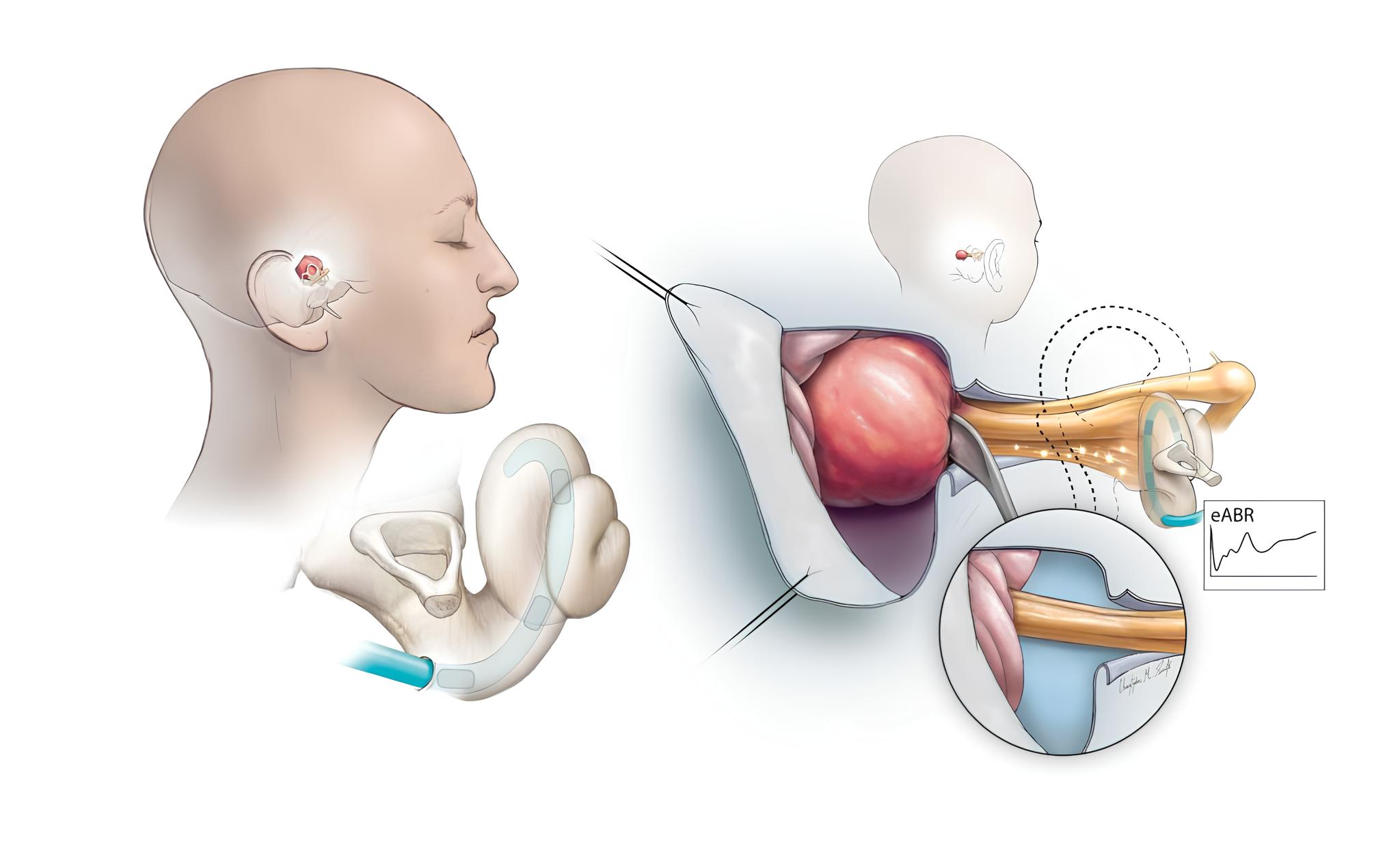 Resimde, kulaktaki bir koklear implantın işitme siniri boyunca nasıl bir sinyal gönderebileceği gösterilmektedir. Ameliyat sırasında tümör çıkarıldığından, bu sinyal cerrahların işitme sinirinin sağlığını izlemesine yardımcı olur.