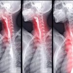 Baryum Yutma Testi Nedir