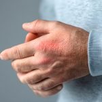 Su Yumuşatma Tuzu Alerjik Reaksiyona Neden Olabilir mi?