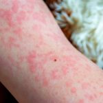 Kronik Kurdeşen İçin 5 Yaşam Tarzı İpucu