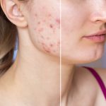 PCOS ve Cilt Sağlığı: Akne ve Diğer Cilt Belirtileri ile Nasıl Baş Edilir?