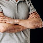 Sedef Hastalığı İçin 14 Doğal ve Evde Uygulanabilecek Tedavi Yöntemi