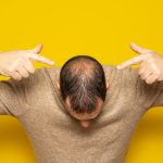 Sedef Hastalığına Bağlı Saç Dökülmesi Mi Yaşıyorsunuz? Saç Kaybını Azaltmak ve Tedavi Etmek İçin İpuçları