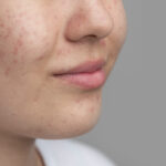 Yüksek Kortizol Seviyeleri ve Olası Nedenleri