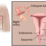 Rahim Ağzı Kanseri