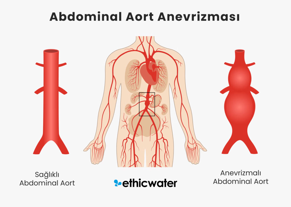 Abdominal Aort Anevrizması: Genel Bakış, Belirtiler, Nedenler, Tanı ve Tedavi