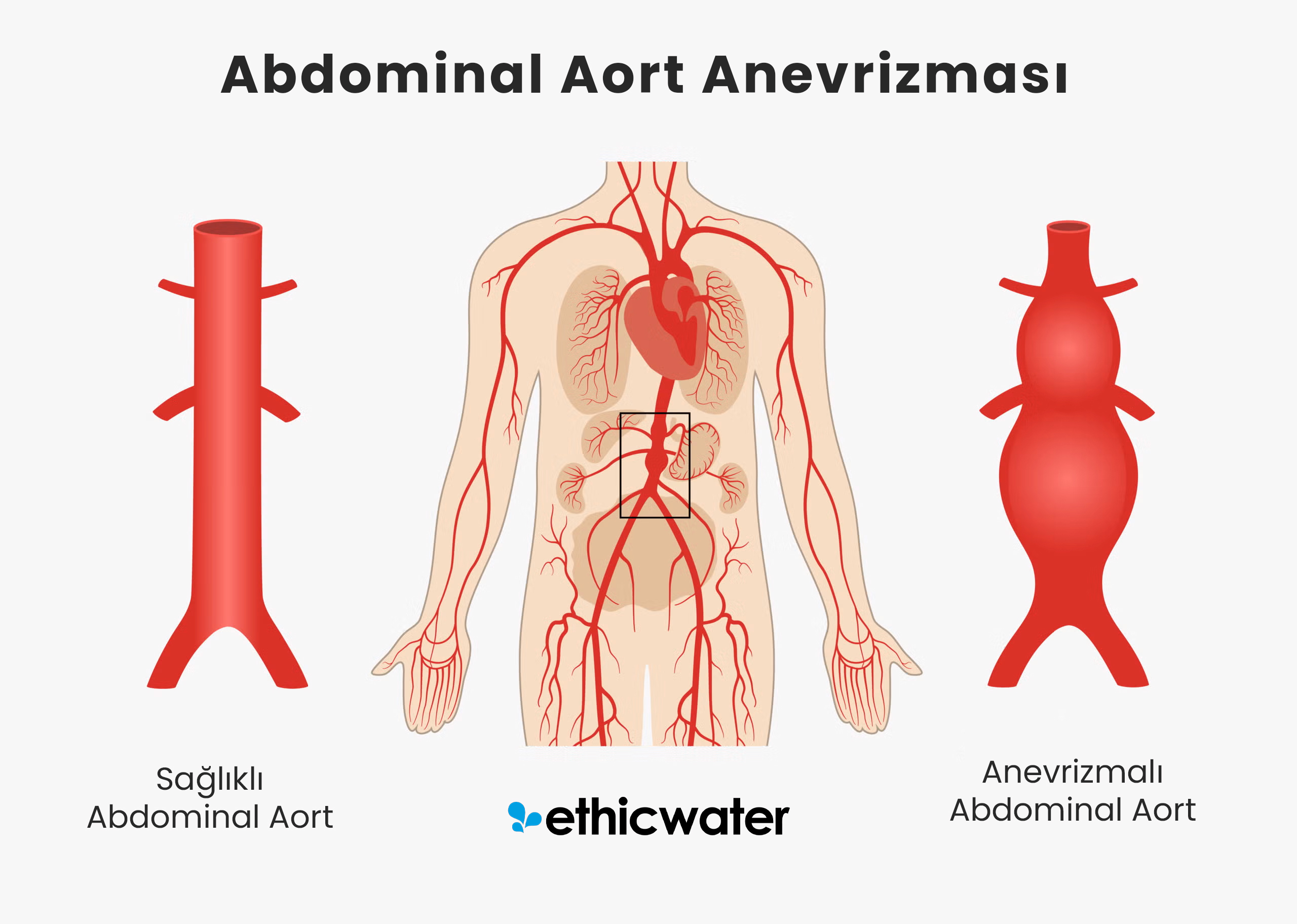 Abdominal Aort Anevrizması: Genel Bakış, Belirtiler, Nedenler, Tanı ve Tedavi
