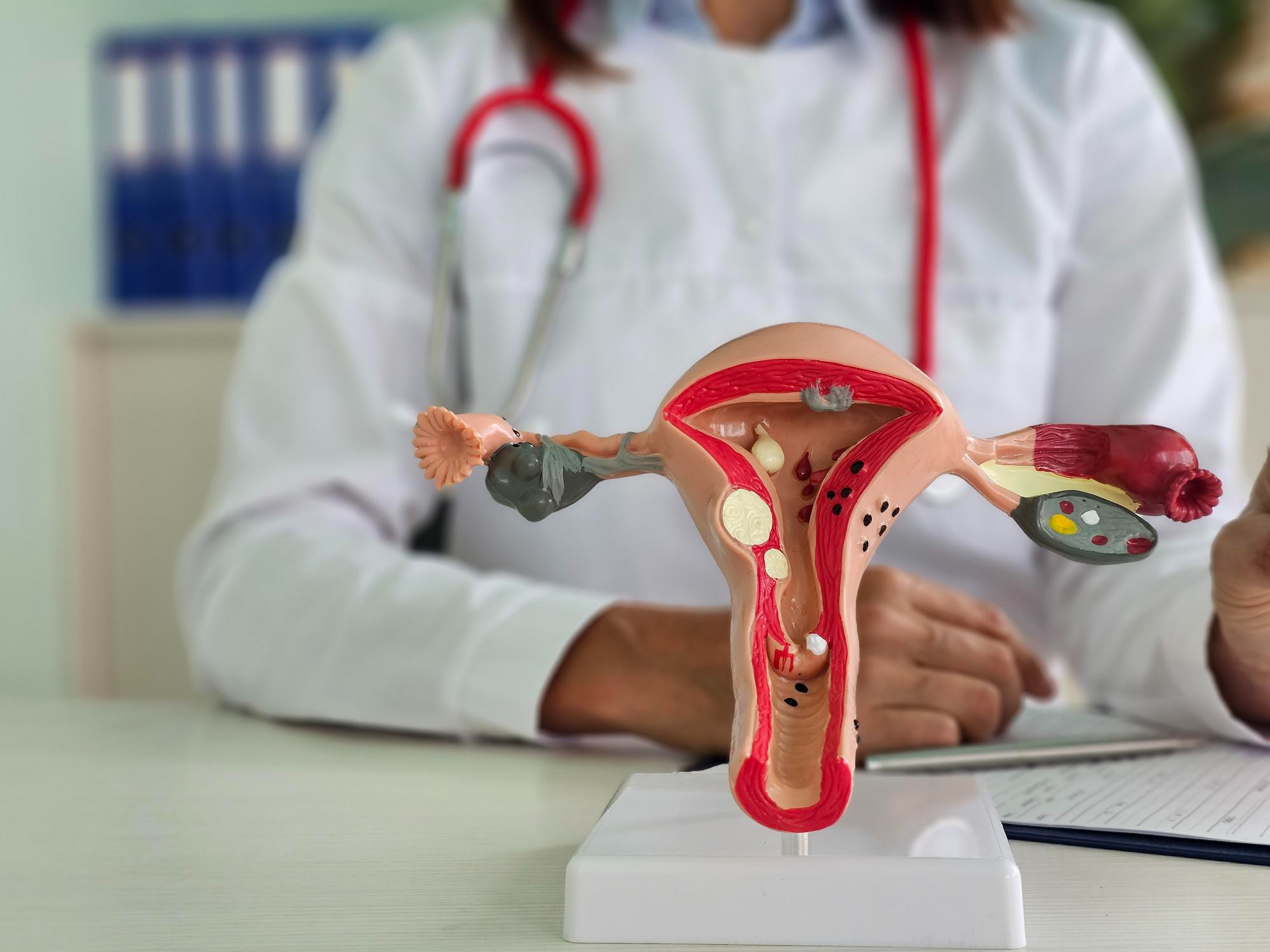 Adenomyozis: Rahim Duvarında Rahim İç Zarının Büyümesi