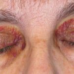 Amiloidoz Nedir? Belirtileri, Nedenleri ve Tedavi Yöntemleri