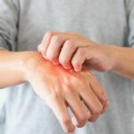 Anafilaksi Nedir? Belirtileri, Tedavisi ve Önleme Yöntemleri