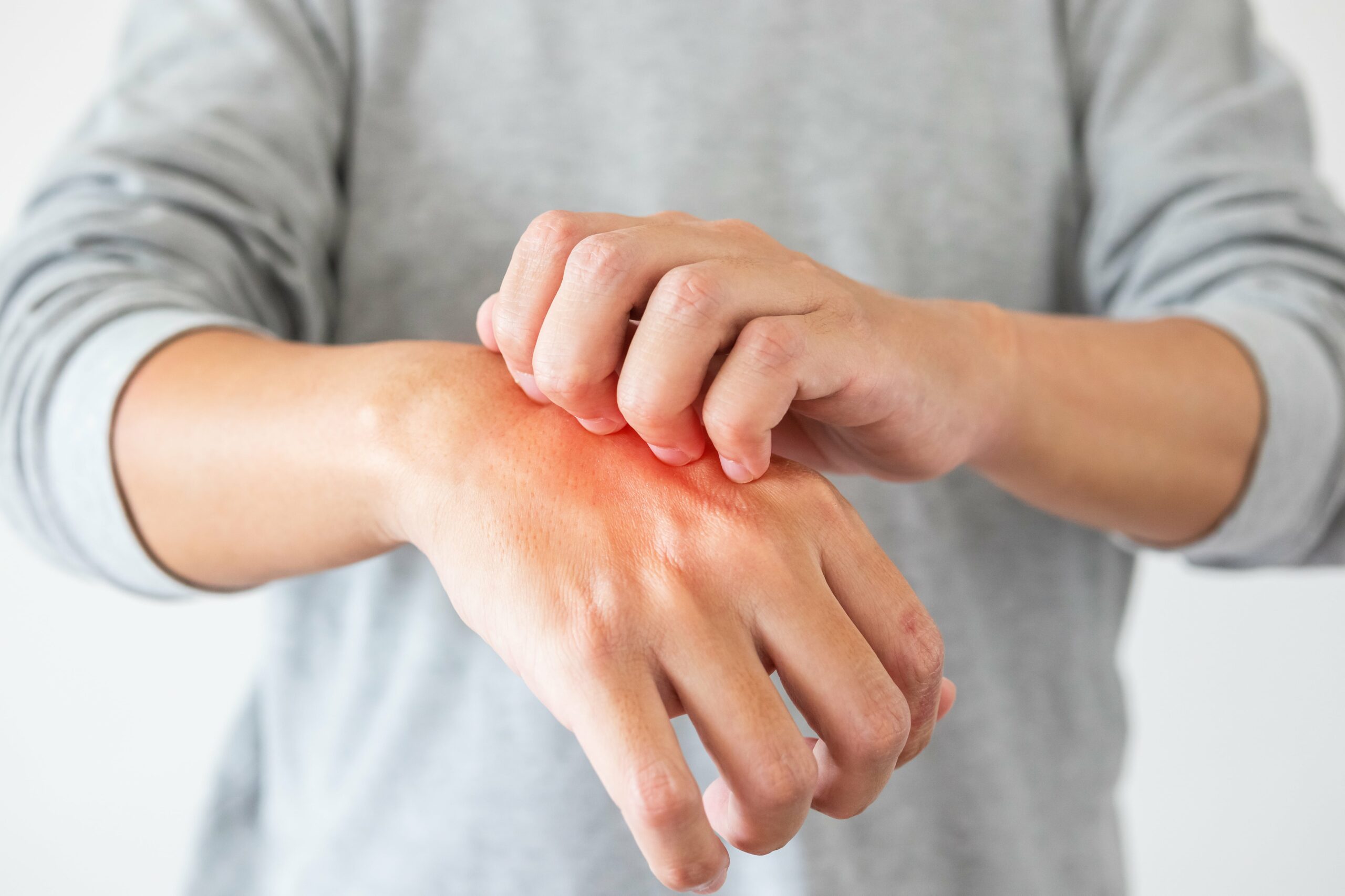 Anafilaksi Nedir? Belirtileri, Tedavisi ve Önleme Yöntemleri