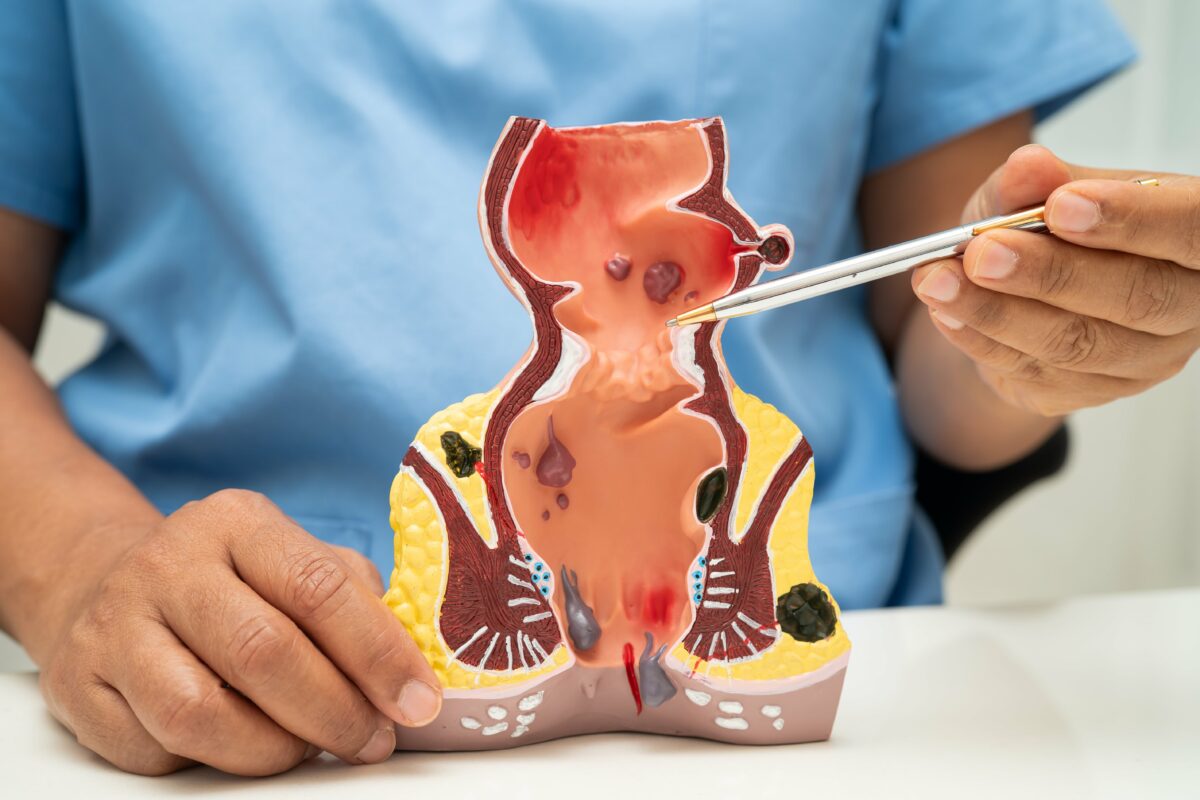 Anal Kanser: Belirtileri, Nedenleri ve Tedavisi