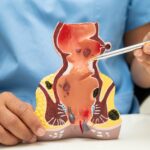 Anal Kanser: Belirtileri, Nedenleri ve Tedavisi