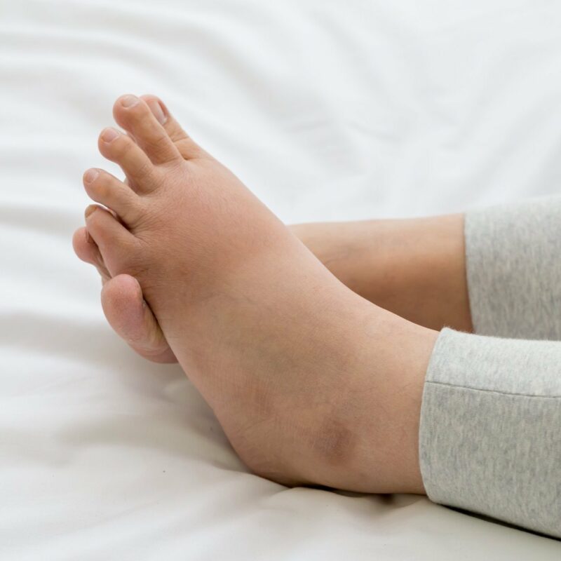 Anjioödem Nedir? Belirtileri, Nedenleri ve Tedavisi