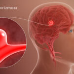 Beyin Anevrizması Nedir? Belirtileri, Nedenleri, Tanı ve Tedavisi