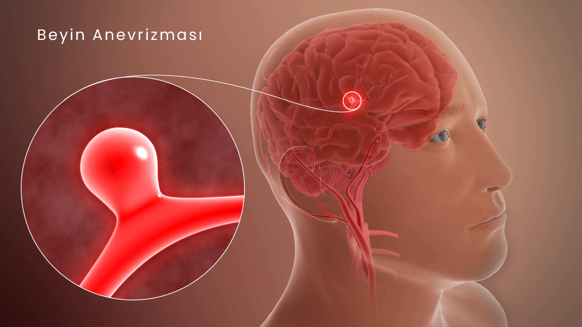 Beyin Anevrizması Nedir? Belirtileri, Nedenleri, Tanı ve Tedavisi