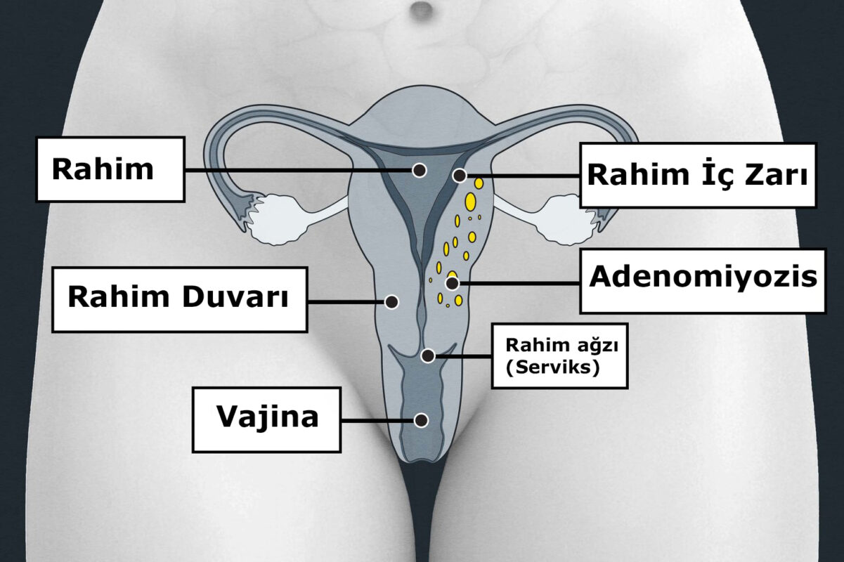 Karın bölgesinin diyagramı: Rahim, rahim duvarı, rahim iç zarı, vajina ve serviks etiketli. Rahim duvarında küçük adenomyozis yamaları büyüyor. Multimedia Team - nhs.uk