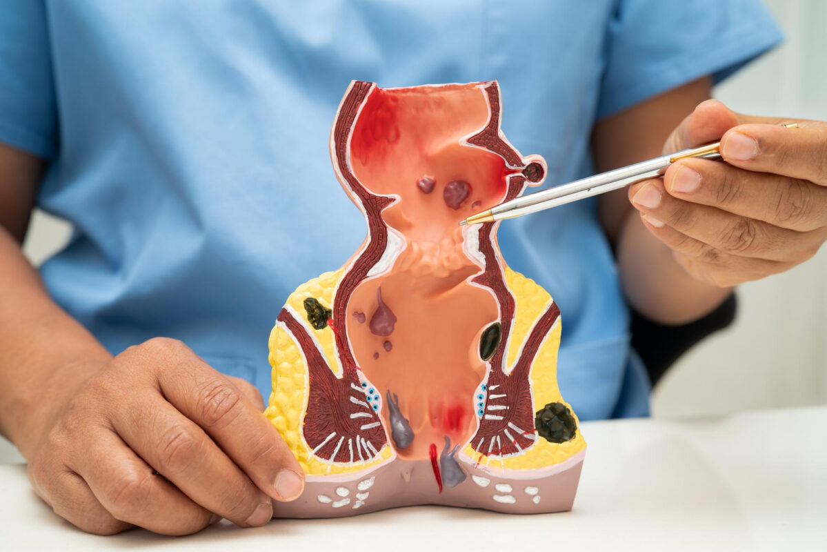 Sfinkterotomi: Kronik Anal Ağrı İçin Cerrahi Tedavi