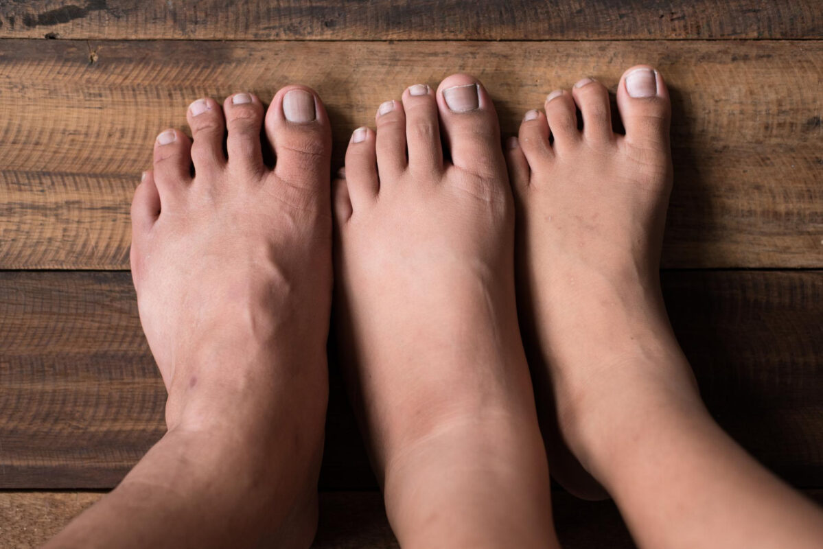 Ayak Bilekleri, Ayaklar ve Bacaklarda Şişlik (Ödem)