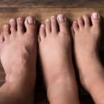 Ayak Bilekleri, Ayaklar ve Bacaklarda Şişlik (Ödem)