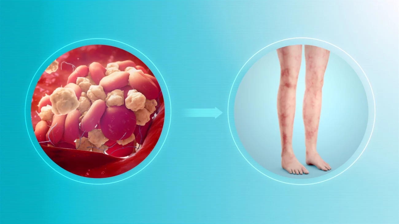 Antifosfolipid Sendromu (APS)