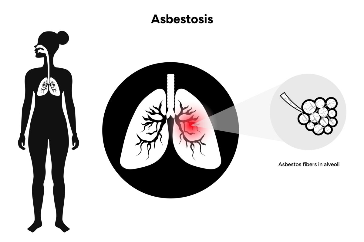 Asbestozis (Asbestoz) Nedir? Belirtileri, Nedenleri ve Tedavisi