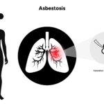 Asbestozis (Asbestoz) Nedir? Belirtileri, Nedenleri ve Tedavisi