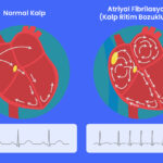 Atriyal Fibrilasyon (Kalp Ritim Bozukluğu)