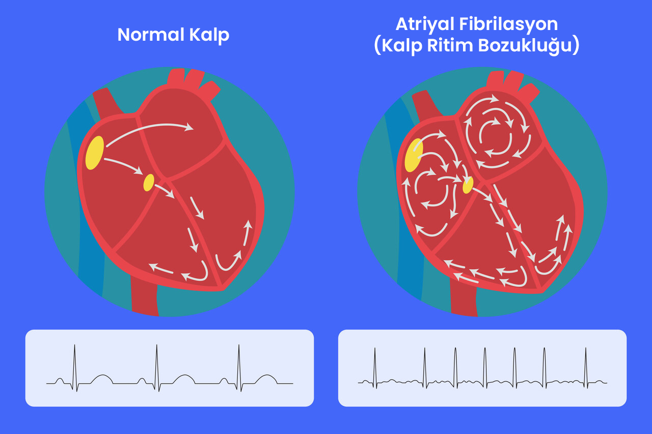 Atriyal Fibrilasyon (Kalp Ritim Bozukluğu