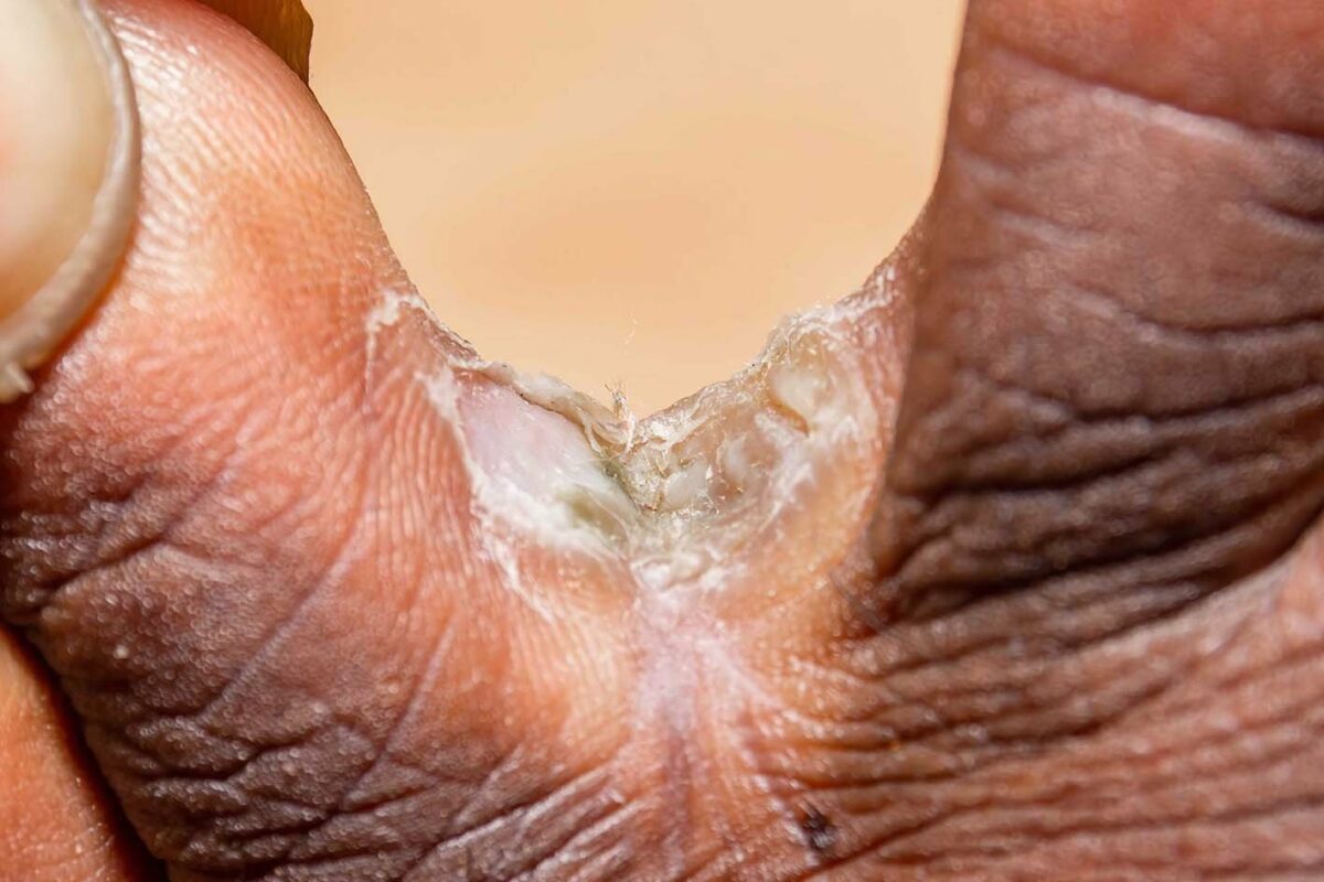 Ayak Mantarı Nedir? Belirtileri ve Tedavi Yöntemleri