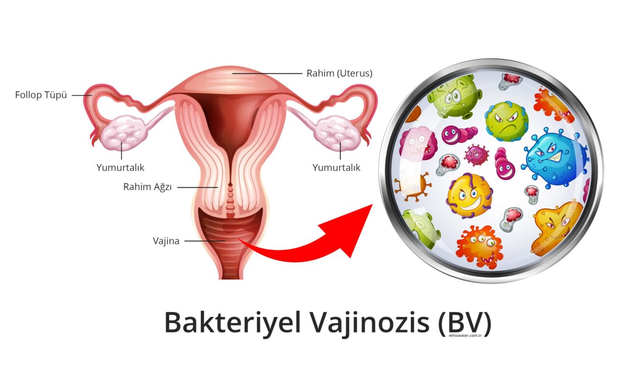 Bakteriyel Vajinozis (BV)