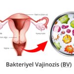 Bakteriyel Vajinozis (BV)