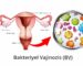 Bakteriyel Vajinozis (BV)