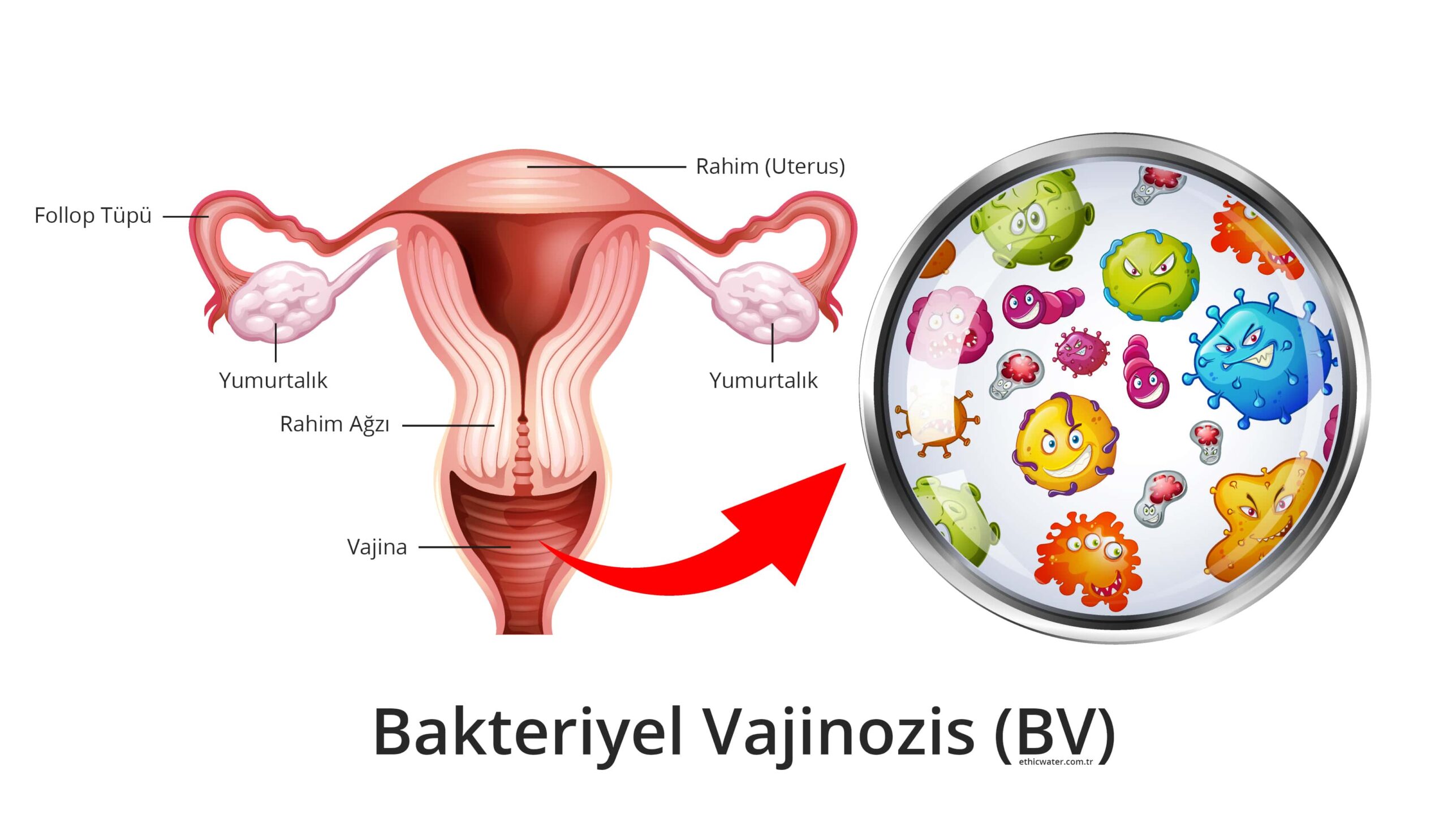 Bakteriyel Vajinozis (BV)
