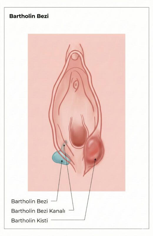 Bartholin Bezi Kisti