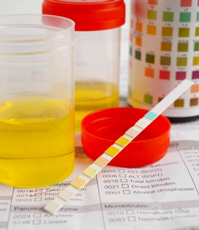 İdrar Rengi ve Değişiklikleri