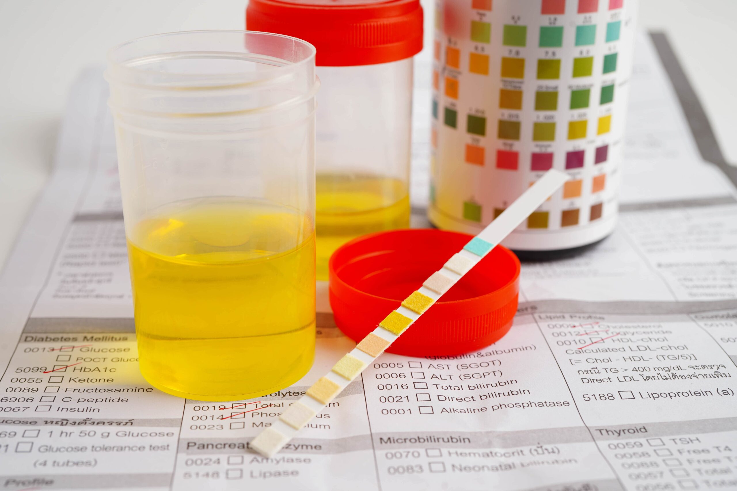 İdrar Rengi ve Değişiklikleri