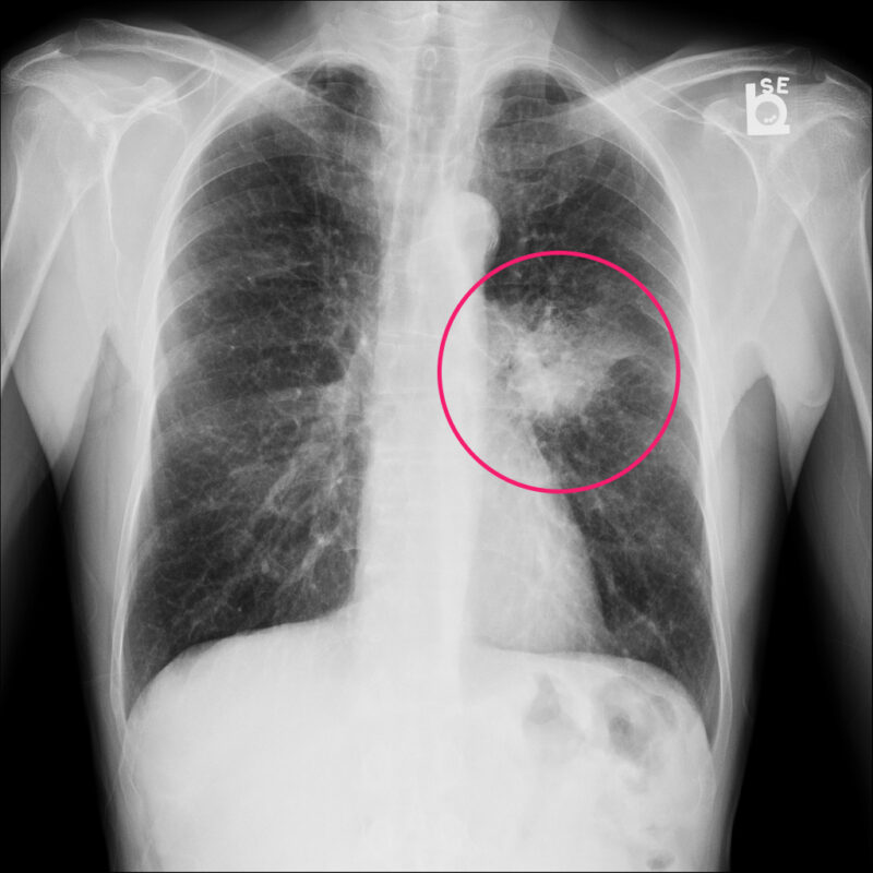 akciğer röntgeni perihiler opasite örneği