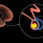 Adenom Nedir? Çeşitleri, Belirtileri ve Tedavisi