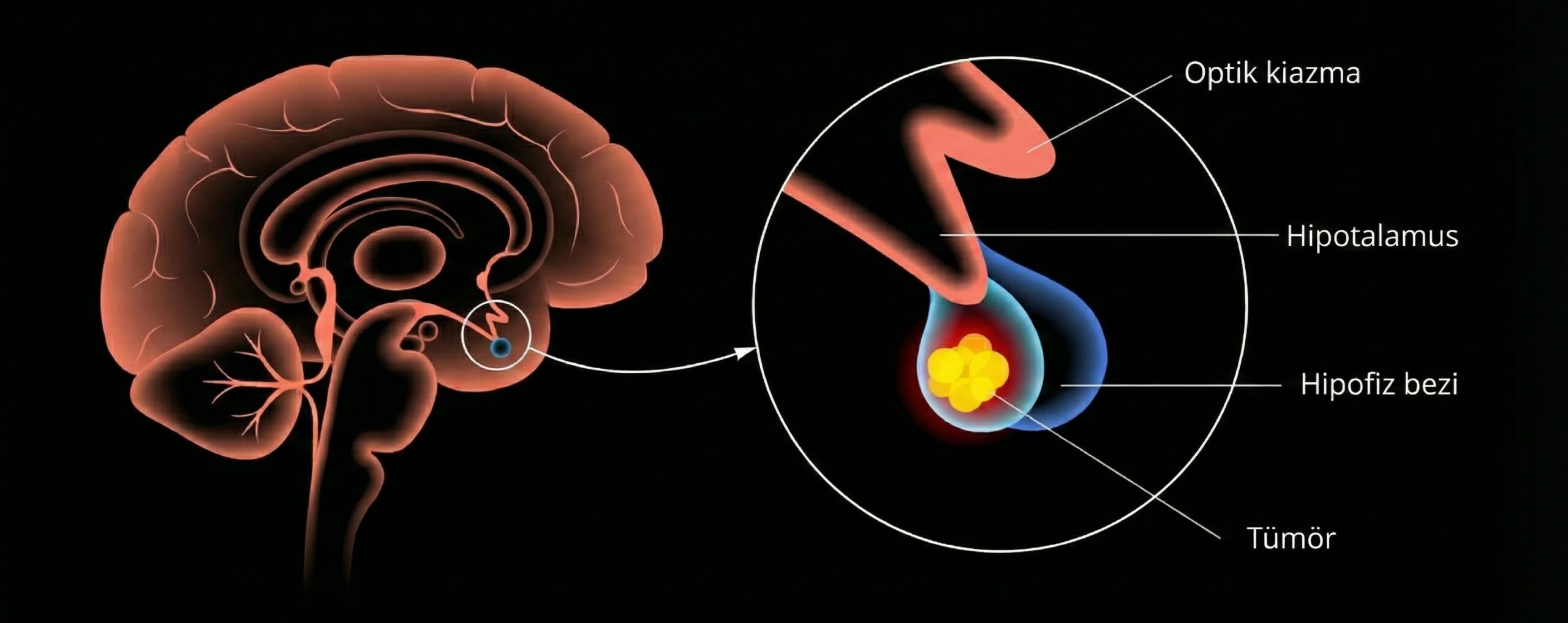 Adenom Nedir? Çeşitleri, Belirtileri ve Tedavisi - Hipofiz Adenomu