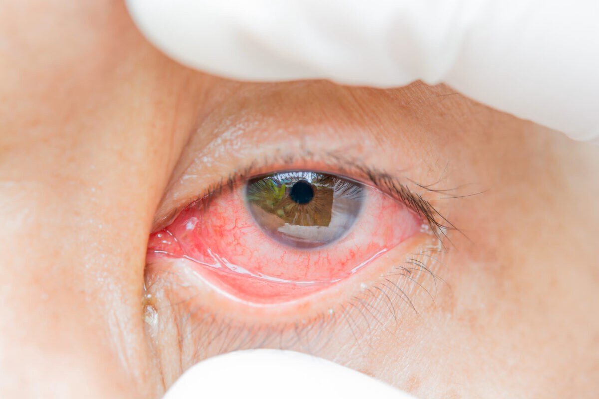 Göz Bulguları: Konjonktivit ve Keratokonjonktivit