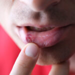 Ağız Yarası Nasıl Geçer? Etkili ve Güvenli Rehber