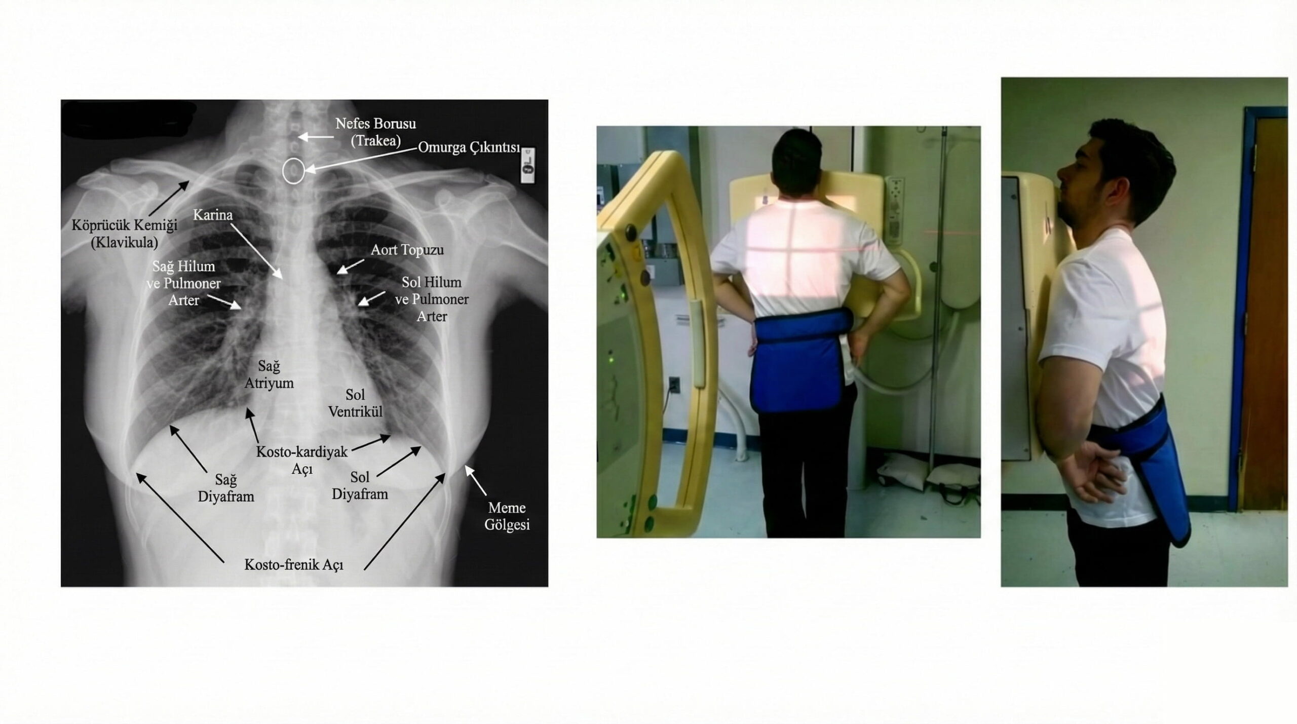 Akciğer Grafisi Nedir ve Nasıl Çekilir?