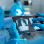 Akciğer Nakli Nedir? Neden Yapılır ve Süreci