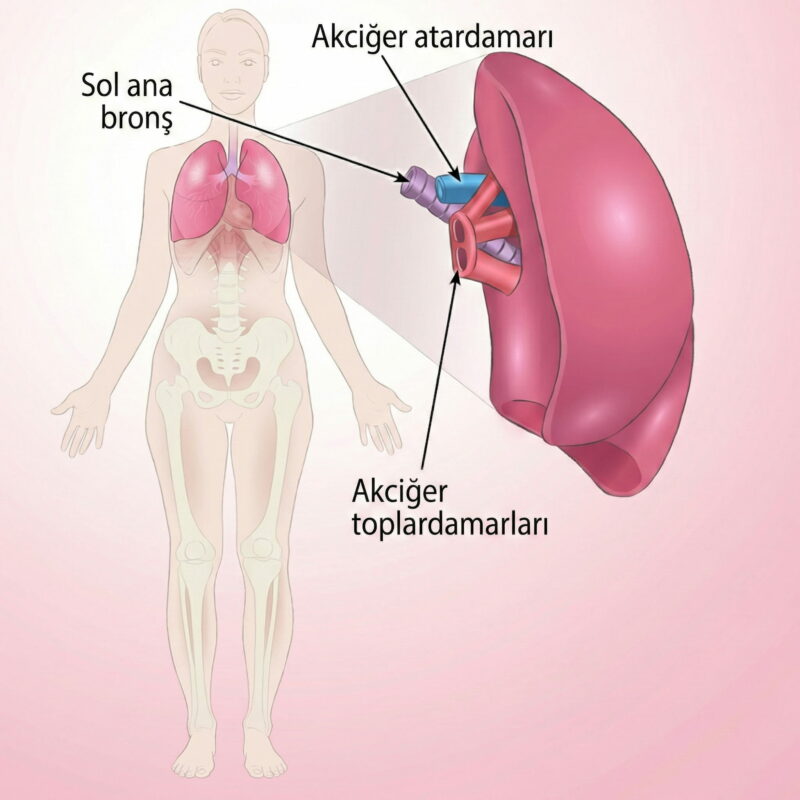 Donör akciğerin bağlanması