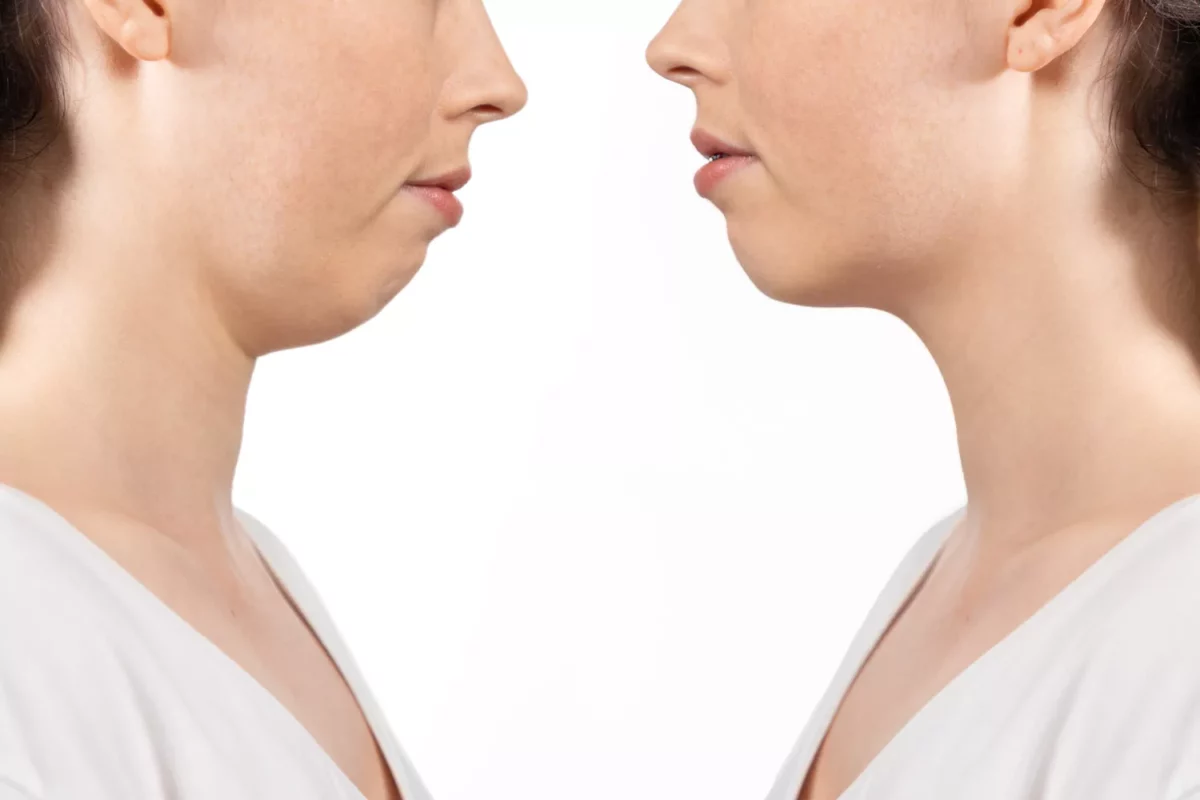 Çene Geriliği: Nedenleri, Belirtileri ve Tedavisi