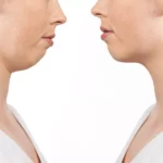 Çene Geriliği: Nedenleri, Belirtileri ve Tedavisi