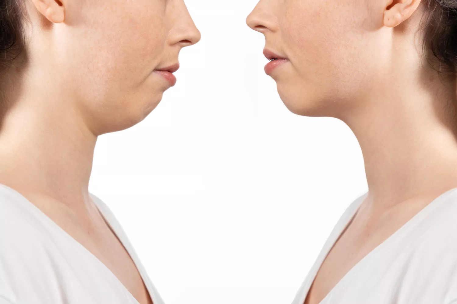 Çene Geriliği: Nedenleri, Belirtileri ve Tedavisi