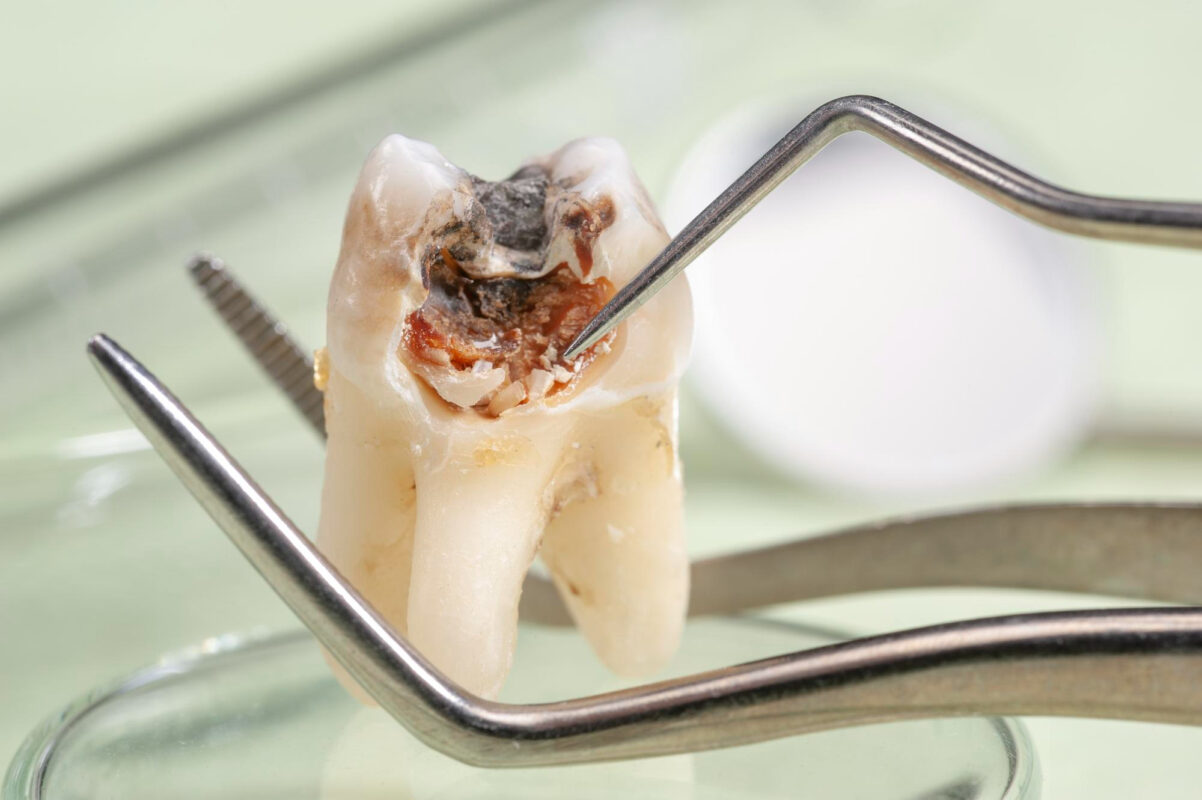 Çürük Diş: Nedenleri, Ağrı ve Çözüm Yolları