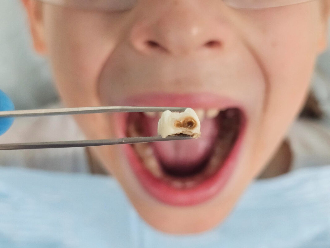 Diş Çürükleri ve Diş Kaybını Önleme Rehberi